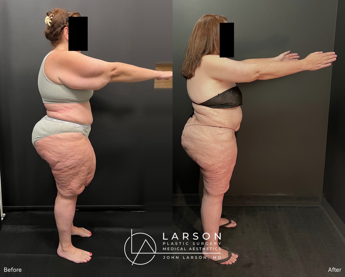 “Before and after lipedema arm liposuction with brachioplasty and forearm lift in a 50-year-old woman, Newport Beach”