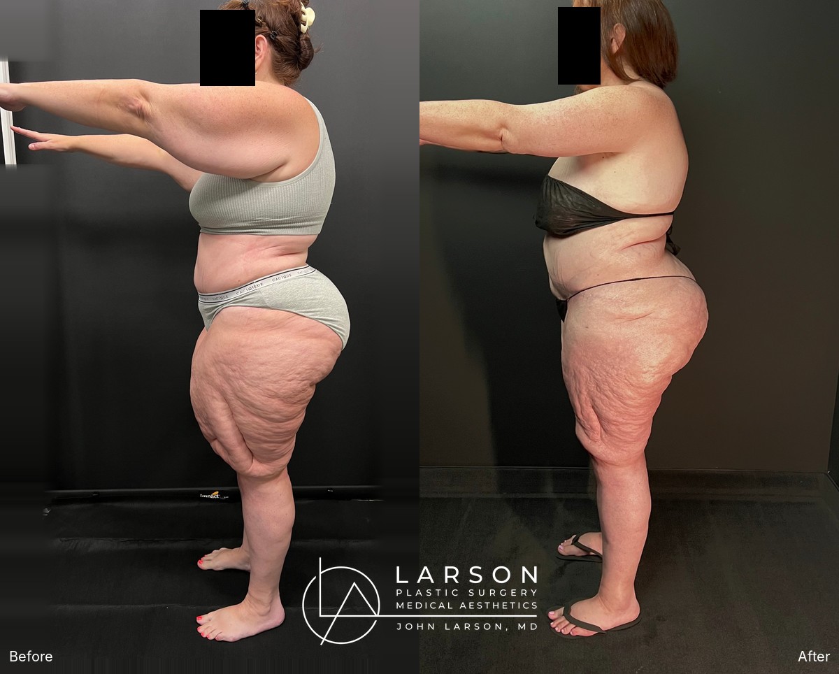 Before and after lipedema arm liposuction with brachioplasty and forearm lift in a 50-year-old woman, Newport Beach”