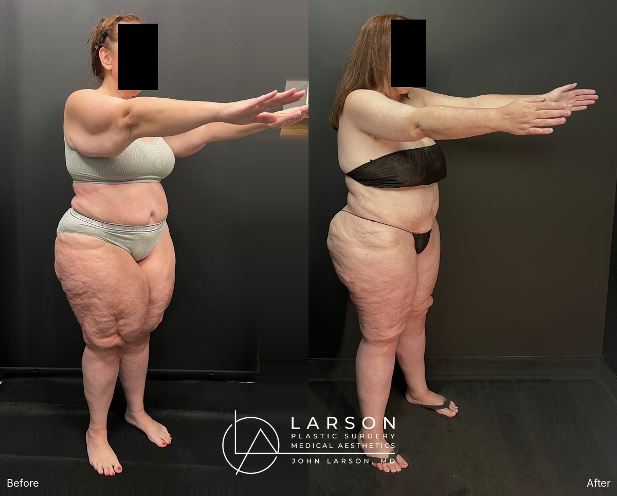 “Before and after lipedema arm liposuction with brachioplasty and forearm lift in a 50-year-old woman, Newport Beach”