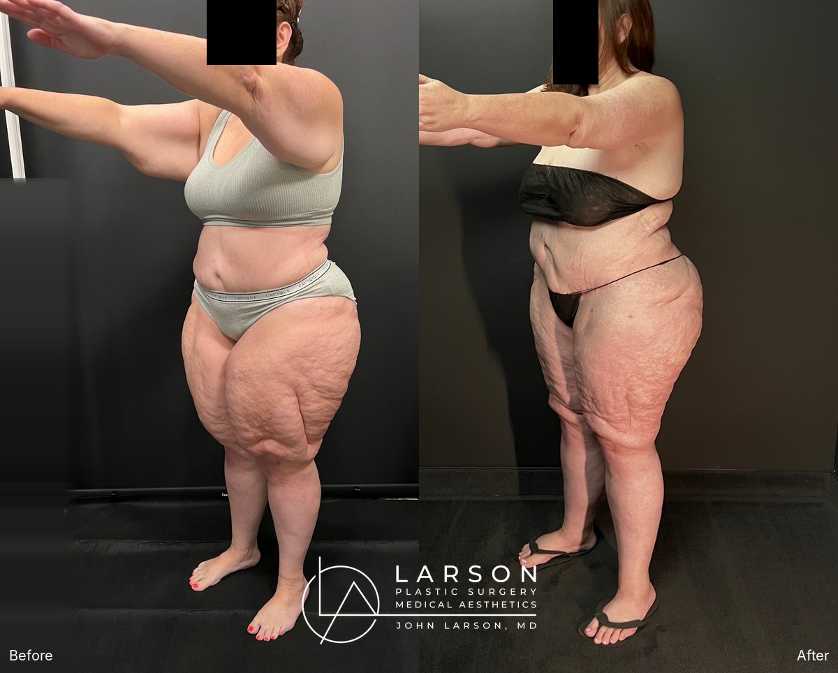 “Before and after lipedema arm liposuction with brachioplasty and forearm lift in a 50-year-old woman, Newport Beach”