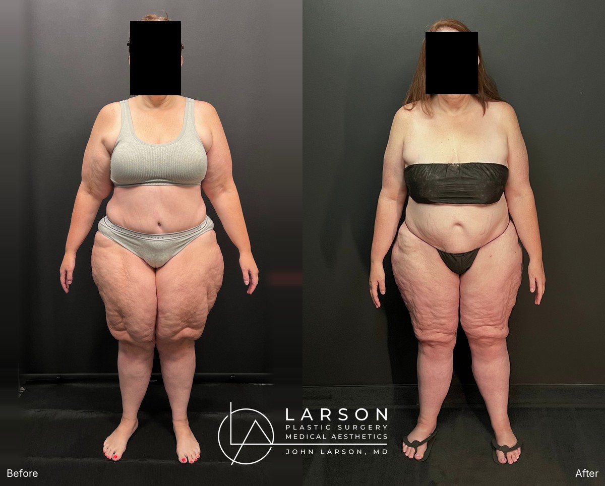 “Before and after staged lipedema surgery in a 50-year-old woman, showing full-leg, hip, and buttock liposuction with thigh and calf lifts, 2 months post-op, Newport Beach”