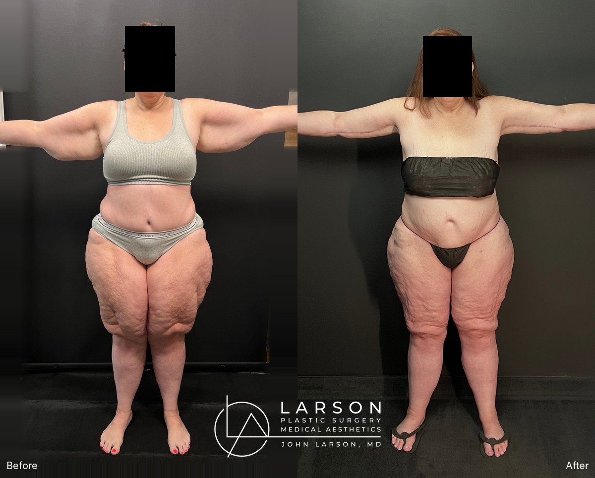 “Before and after lipedema arm liposuction with brachioplasty and forearm lift in a 50-year-old woman, Newport Beach”