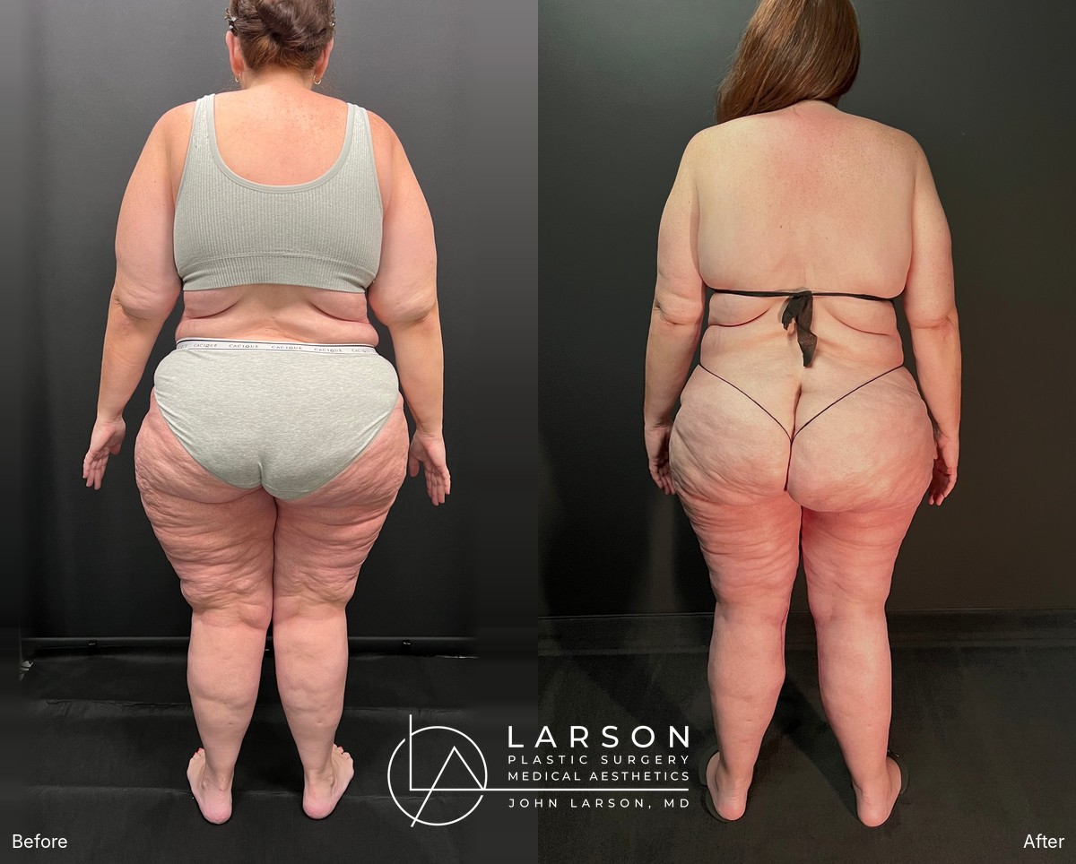 “Before and after staged lipedema surgery in a 50-year-old woman, showing full-leg, hip, and buttock liposuction with thigh and calf lifts, 2 months post-op, Newport Beach”
