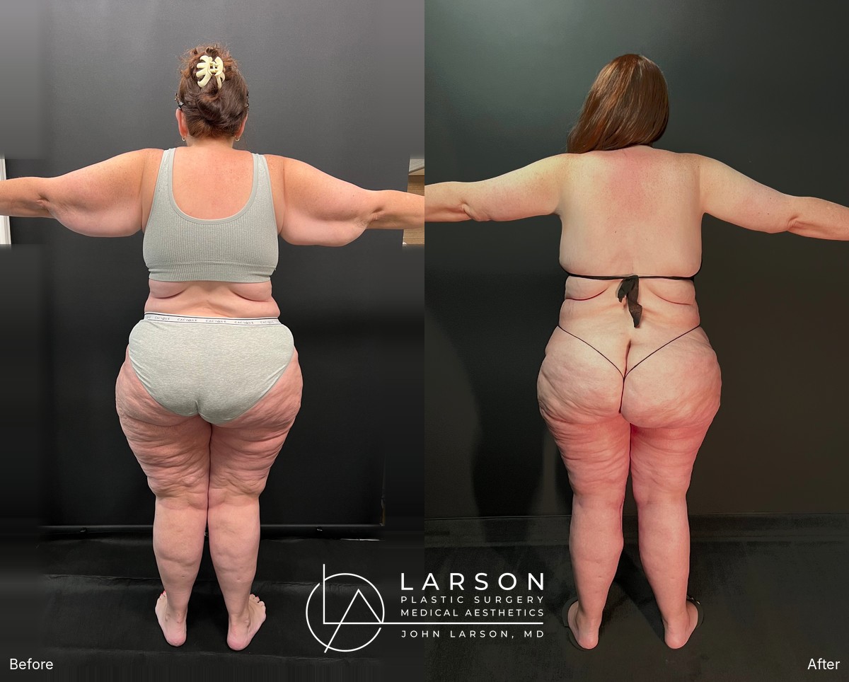 “Before and after lipedema arm liposuction with brachioplasty and forearm lift in a 50-year-old woman, Newport Beach”