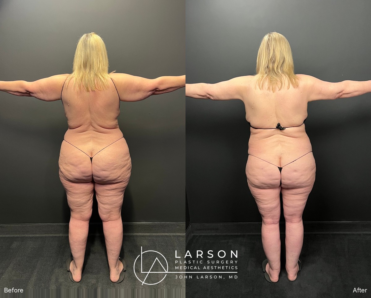 Back view before and after staged lipedema liposuction of the legs, hips, and buttocks in a 60-year-old woman, Newport Beach