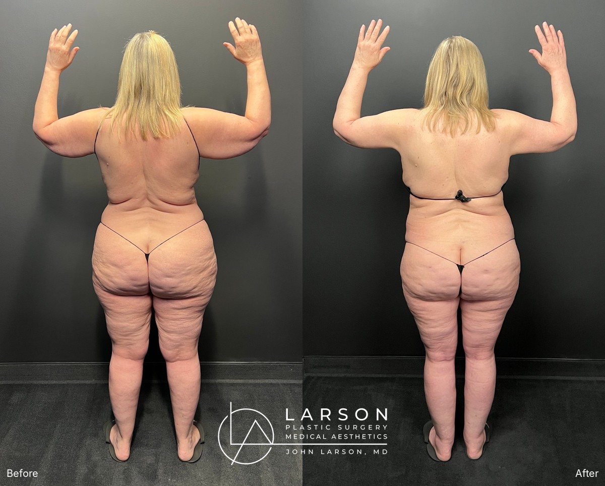 Back view before and after staged lipedema liposuction of the legs, hips, and buttocks in a 60-year-old woman, Newport Beach