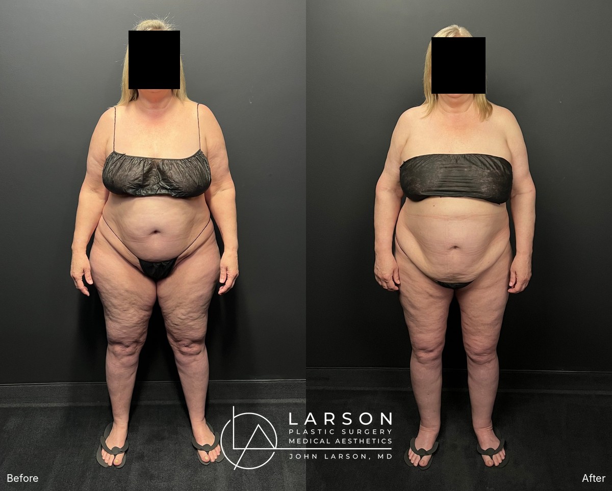 “Before and after staged lipedema surgery in a 60-year-old woman, showing full-leg, hip, and buttock liposuction with thigh and calf lifts, under 2 months post-op, Newport Beach”