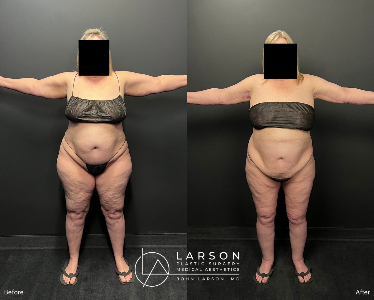 Before and after lipedema arm liposuction with brachioplasty and forearm lift in a 60-year-old woman, Newport Beach