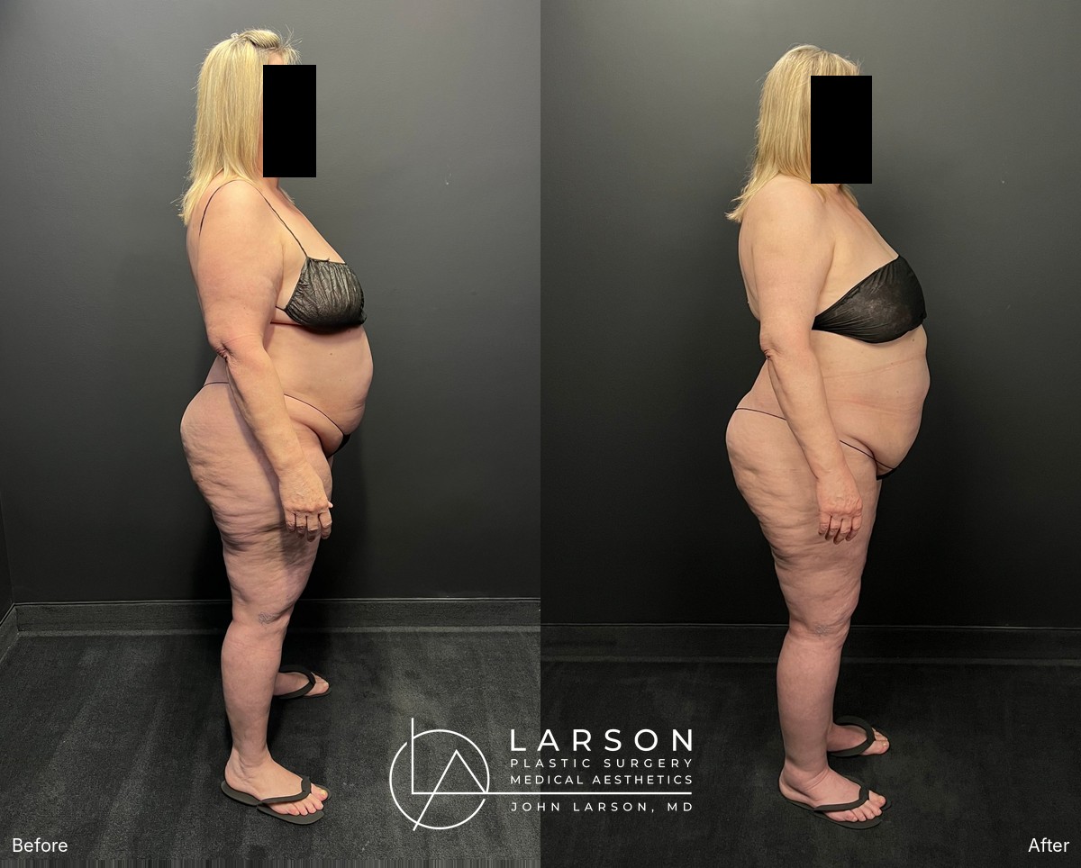 “Before and after staged lipedema surgery in a 60-year-old woman, showing full-leg, hip, and buttock liposuction with thigh and calf lifts, under 2 months post-op, Newport Beach”