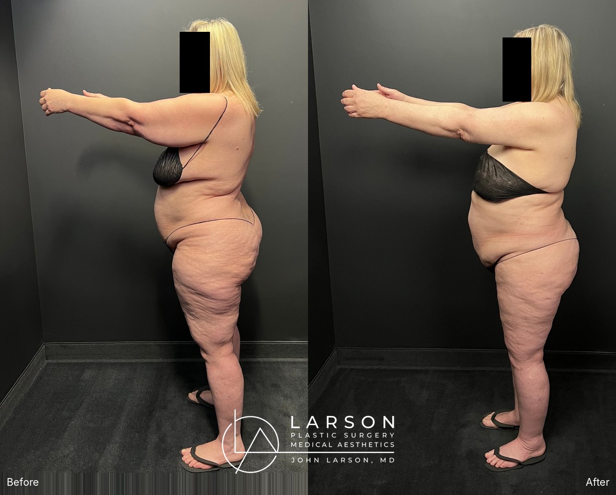 “Before and after lipedema arm liposuction with brachioplasty and forearm lift in a 60-year-old woman, Newport Beach”