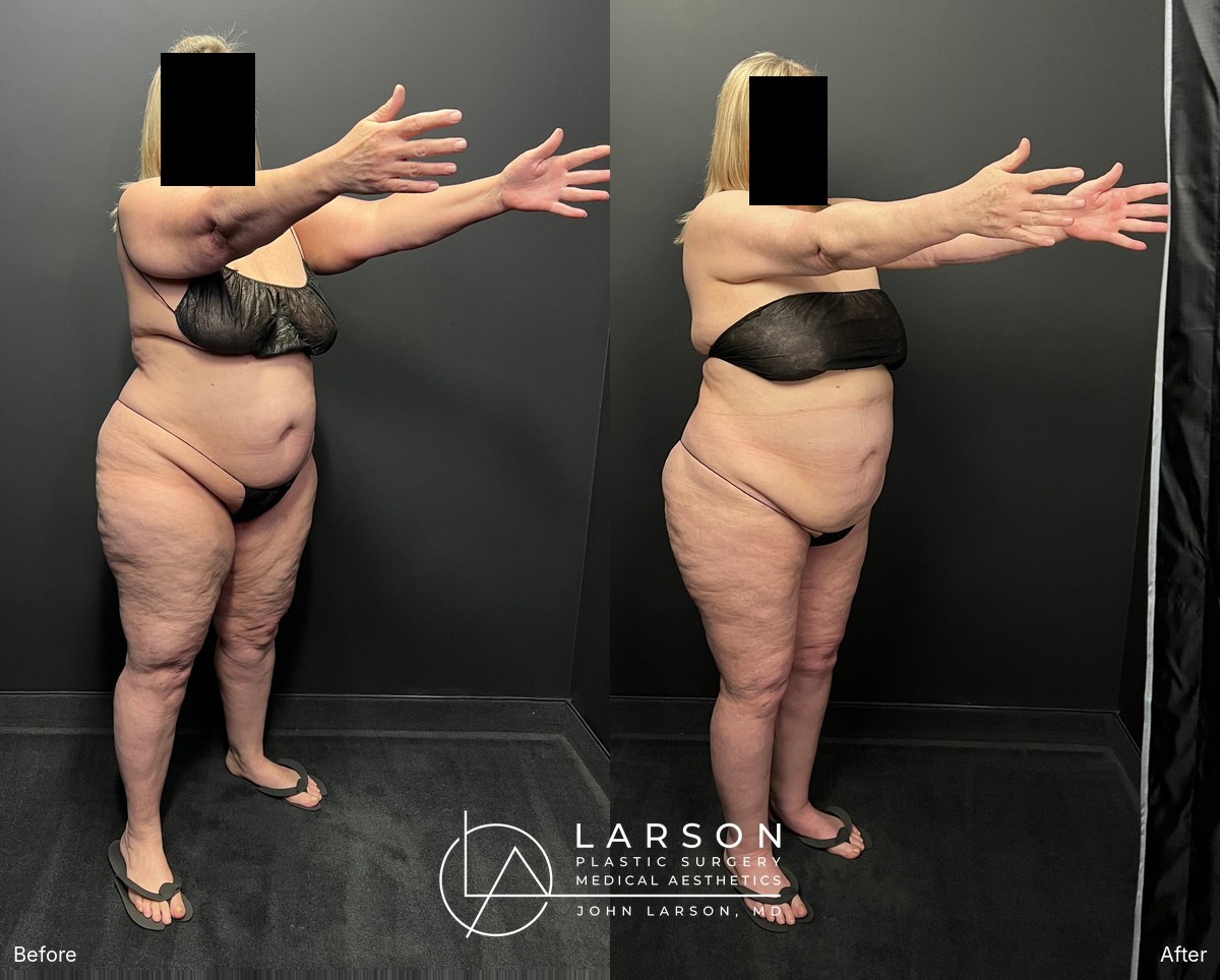Before and after lipedema arm liposuction with brachioplasty and forearm lift in a 60-year-old woman, Newport Beach