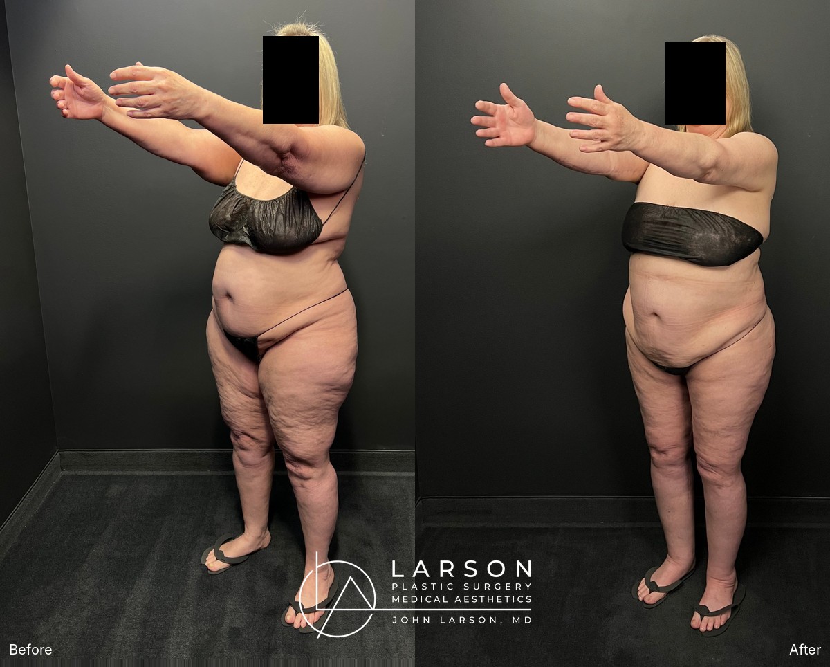 “Before and after lipedema arm liposuction with brachioplasty and forearm lift in a 60-year-old woman, Newport Beach”