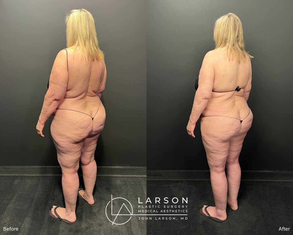Back view before and after staged lipedema liposuction of the legs, hips, and buttocks in a 60-year-old woman, Newport Beach