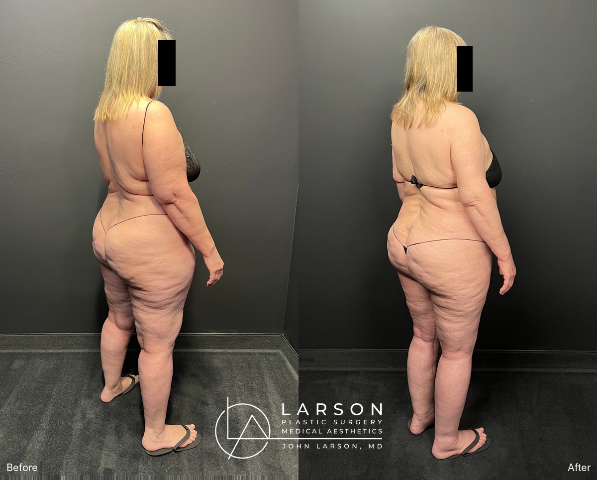 Back view before and after staged lipedema liposuction of the legs, hips, and buttocks in a 60-year-old woman, Newport Beach