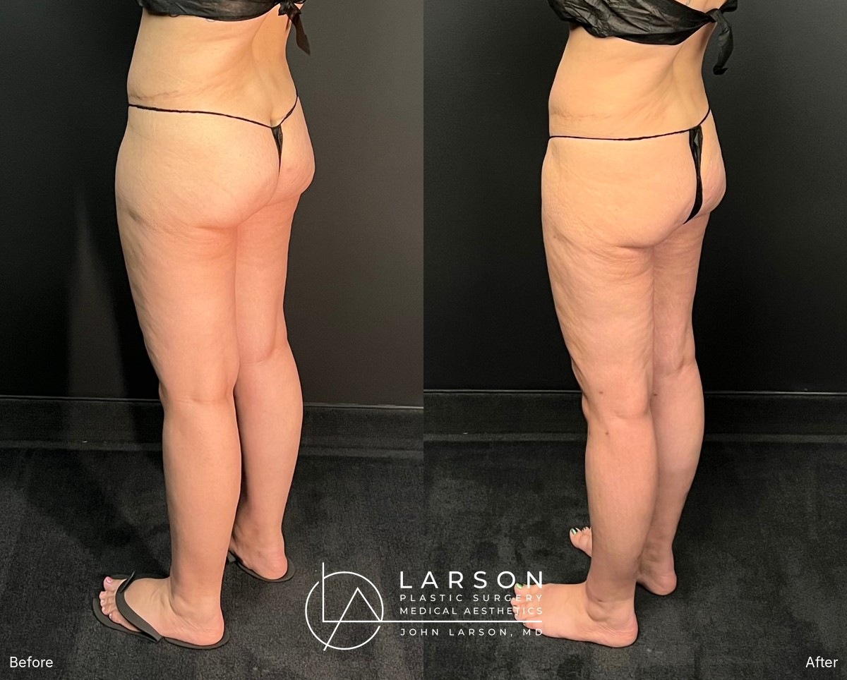 Before and after full-leg lipedema liposuction in a 40-year-old woman, back view, 3 months post-op, Newport Beach