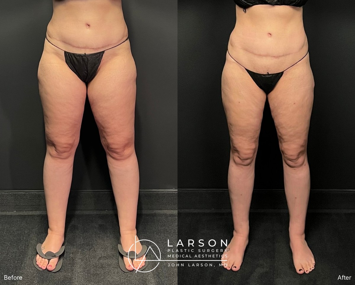 “Before and after full-leg lipedema liposuction in a 40-year-old woman, front view, 3 months post-op, Newport Beach”