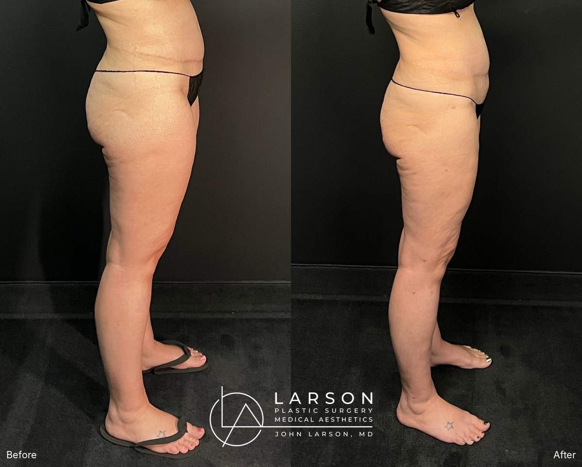 “Before and after full-leg lipedema liposuction in a 40-year-old woman, side view, 3 months post-op, Newport Beach”