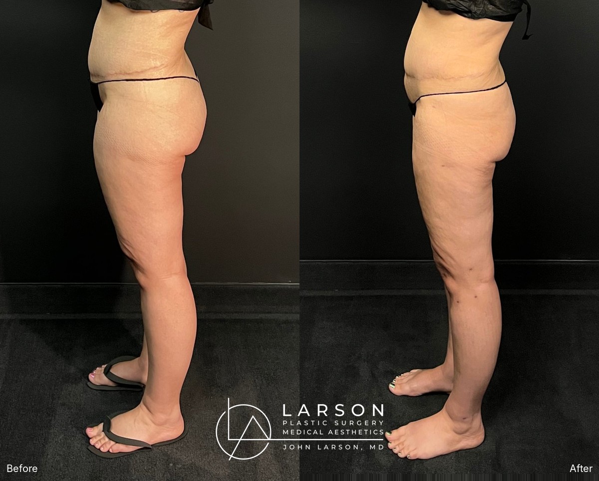 “Before and after full-leg lipedema liposuction in a 40-year-old woman, side view, 3 months post-op, Newport Beach”