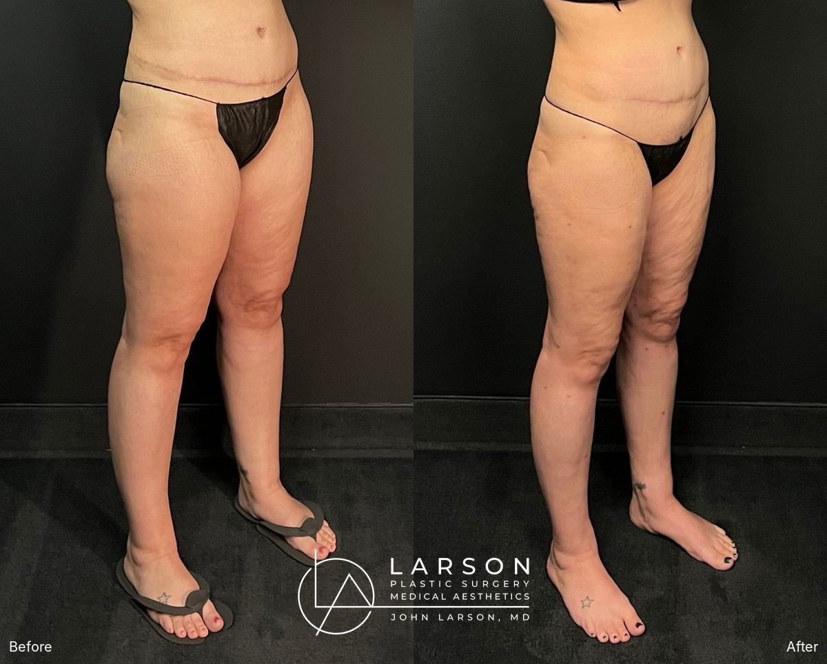 “Before and after full-leg lipedema liposuction in a 40-year-old woman, side view, 3 months post-op, Newport Beach”