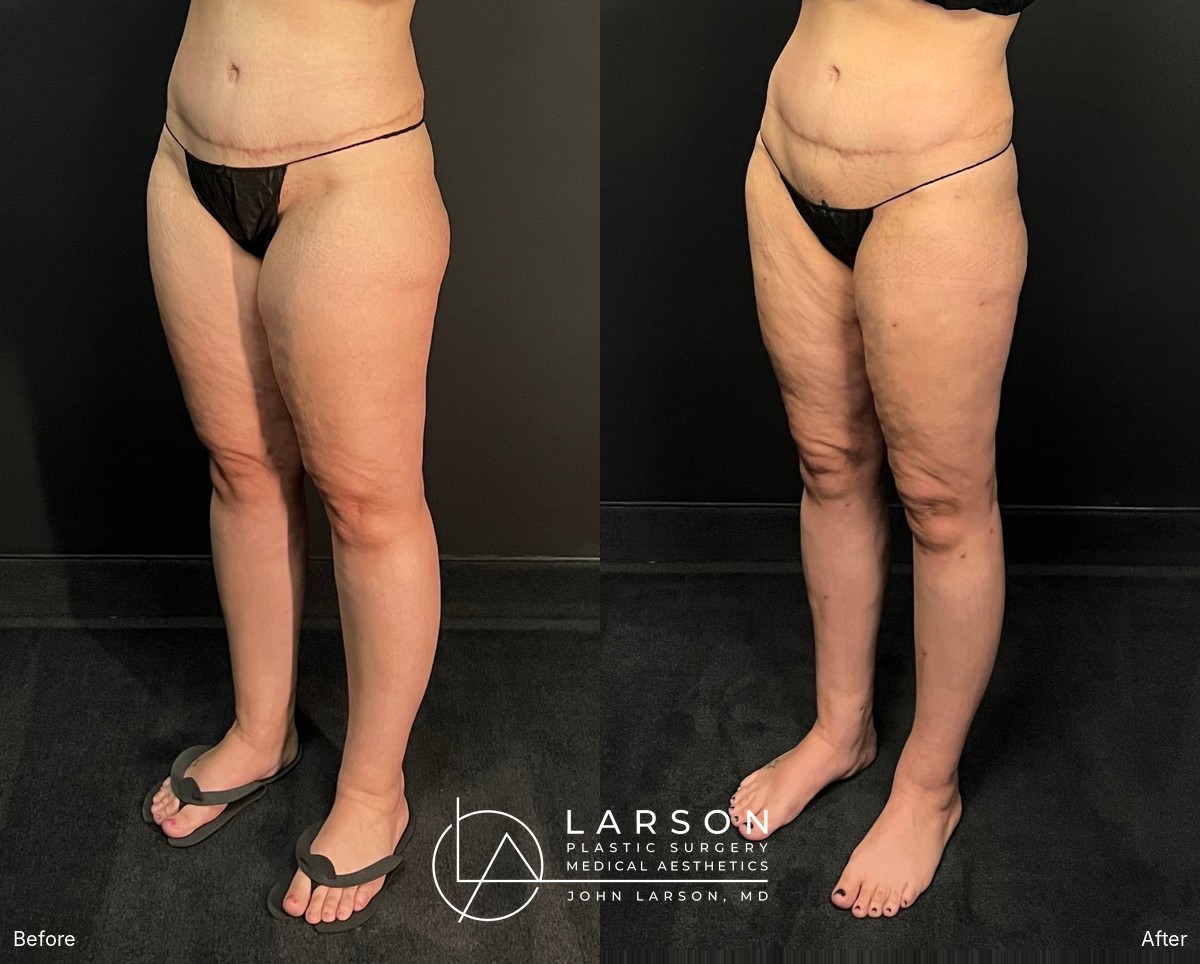 “Before and after full-leg lipedema liposuction in a 40-year-old woman, side view, 3 months post-op, Newport Beach”