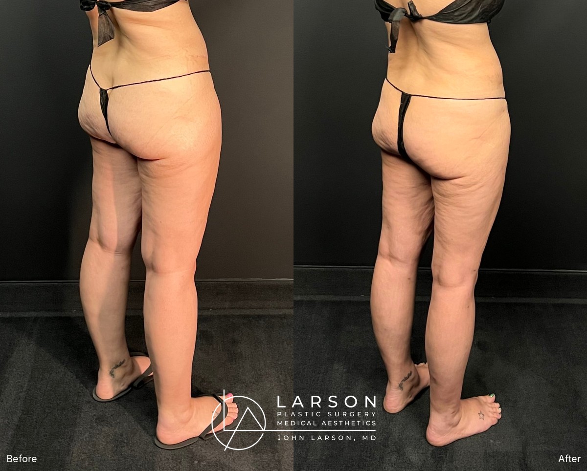 Before and after full-leg lipedema liposuction in a 40-year-old woman, back view, 3 months post-op, Newport Beach