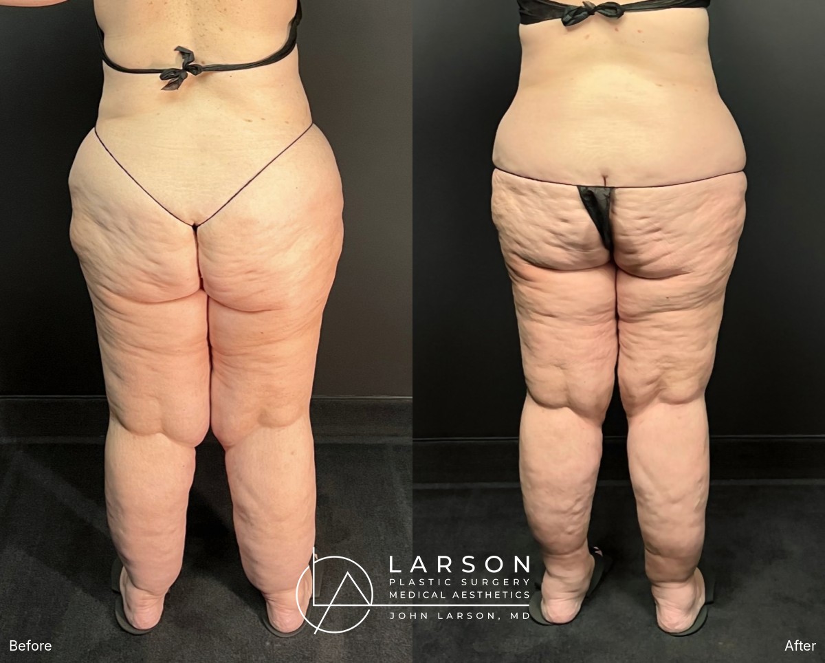 “Before and after full-leg and hip lipedema liposuction in a 56-year-old woman, back view, nearly 3 months post-op, Newport Beach”