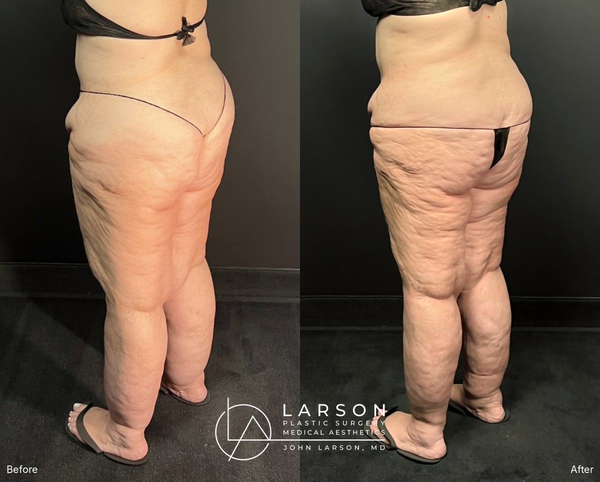 “Before and after full-leg and hip lipedema liposuction in a 56-year-old woman, back oblique view, nearly 3 months post-op, Newport Beach”