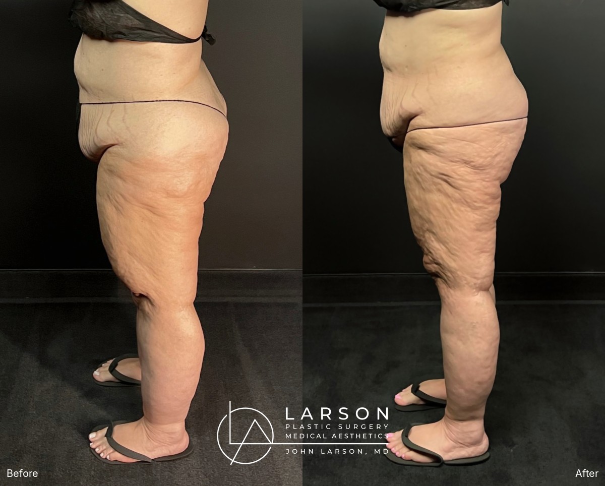 “Before and after full-leg and hip lipedema liposuction in a 56-year-old woman, side view, nearly 3 months post-op, Newport Beach”
