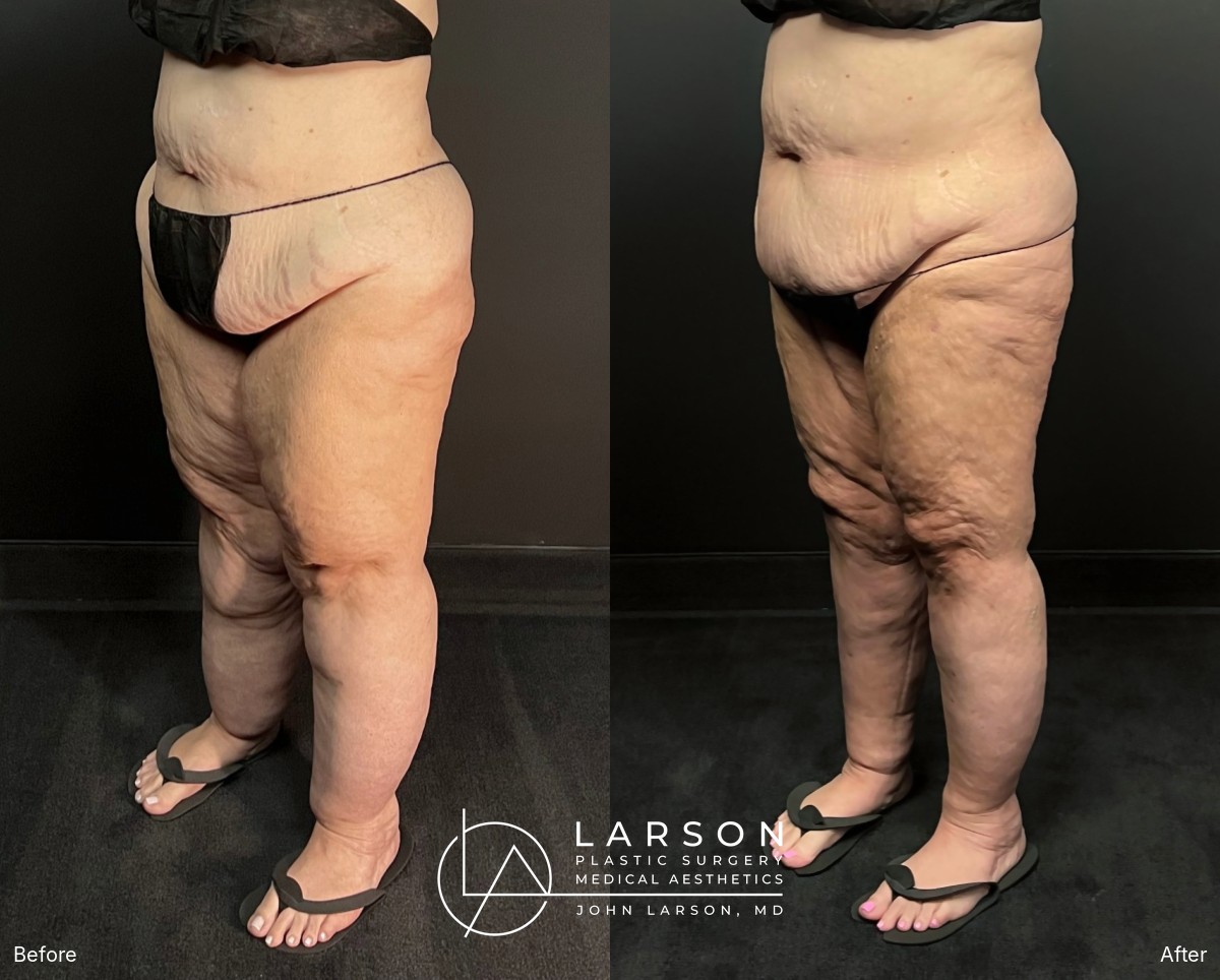 “Before and after full-leg and hip lipedema liposuction in a 56-year-old woman, oblique view, nearly 3 months post-op, Newport Beach”