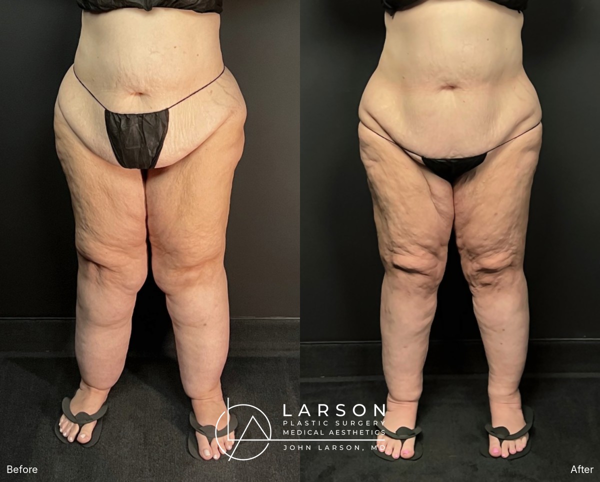 “Before and after full-leg and hip lipedema liposuction in a 56-year-old woman, front view, nearly 3 months post-op, Newport Beach”