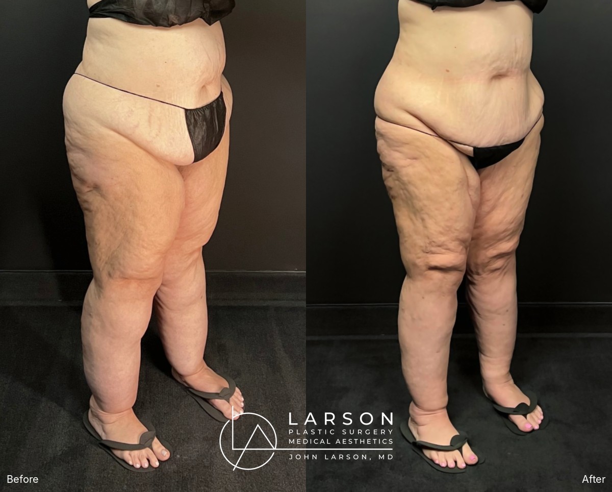 “Before and after full-leg and hip lipedema liposuction in a 56-year-old woman, oblique view, nearly 3 months post-op, Newport Beach”
