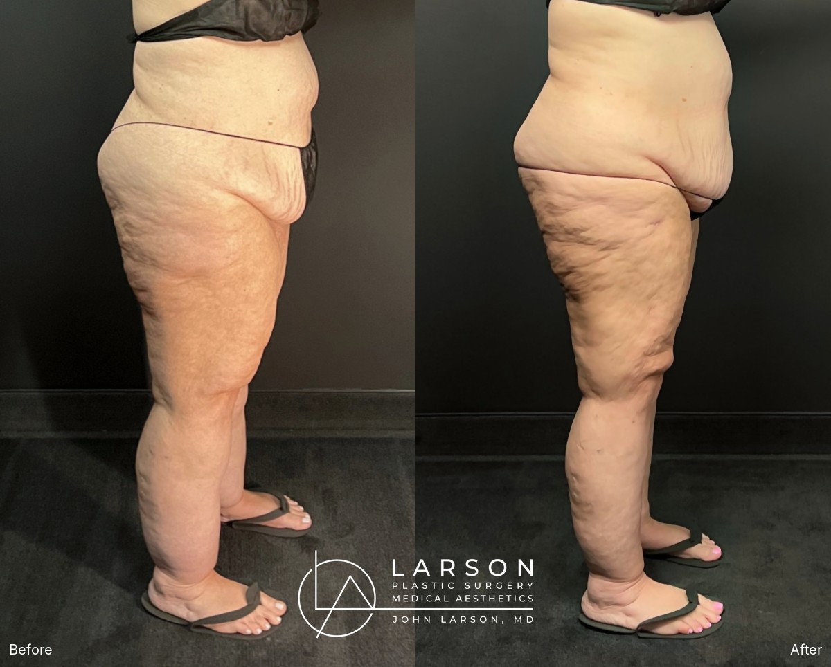 “Before and after full-leg and hip lipedema liposuction in a 56-year-old woman, side view, nearly 3 months post-op, Newport Beach”
