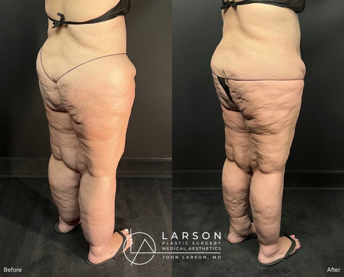 “Before and after full-leg and hip lipedema liposuction in a 56-year-old woman, back oblique view, nearly 3 months post-op, Newport Beach”