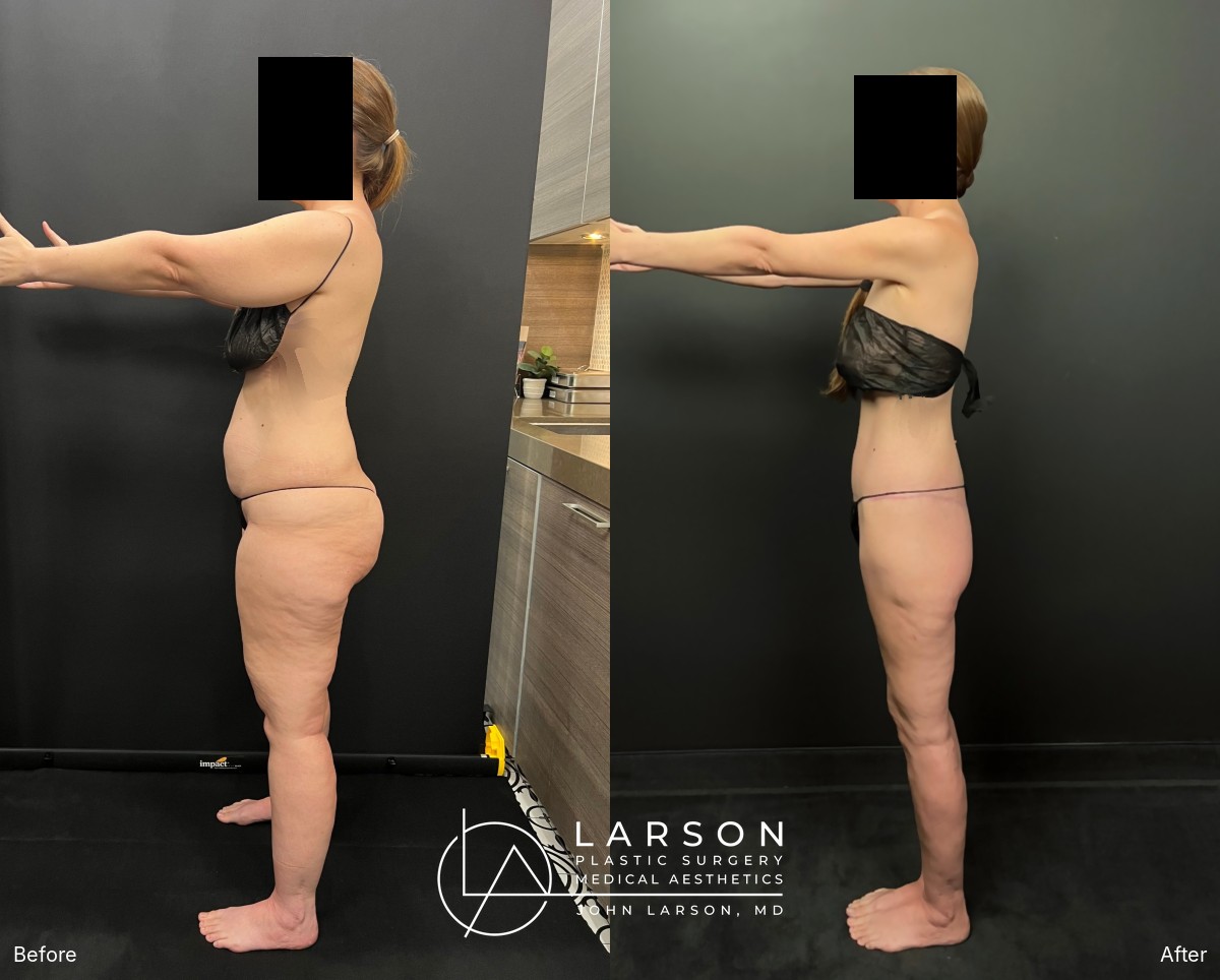 “Before and after staged lipedema liposuction and body lifts in a 42-year-old woman, side view, Newport Beach”
