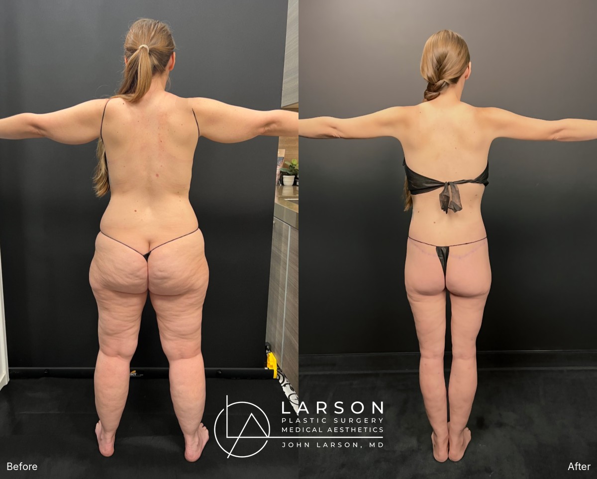 “Before and after staged lipedema liposuction and body lifts in a 42-year-old woman, back view, Newport Beach”