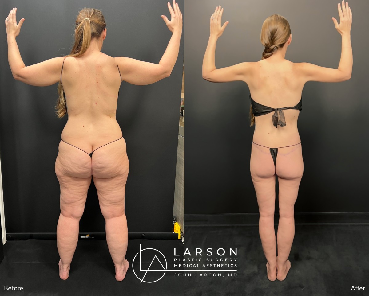 “Before and after staged lipedema liposuction and body lifts in a 42-year-old woman, back view, Newport Beach”