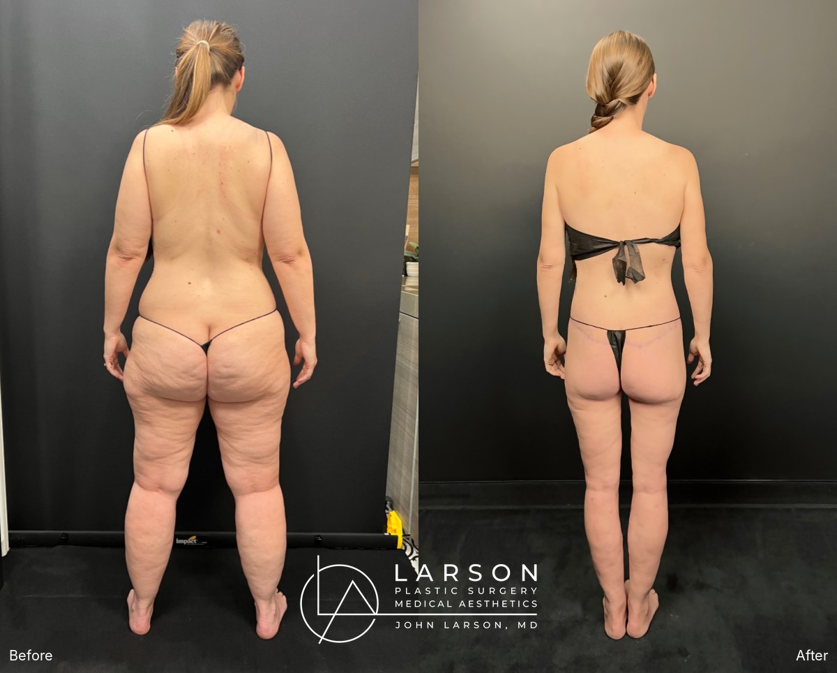“Before and after staged lipedema liposuction and body lifts in a 42-year-old woman, back view, Newport Beach”