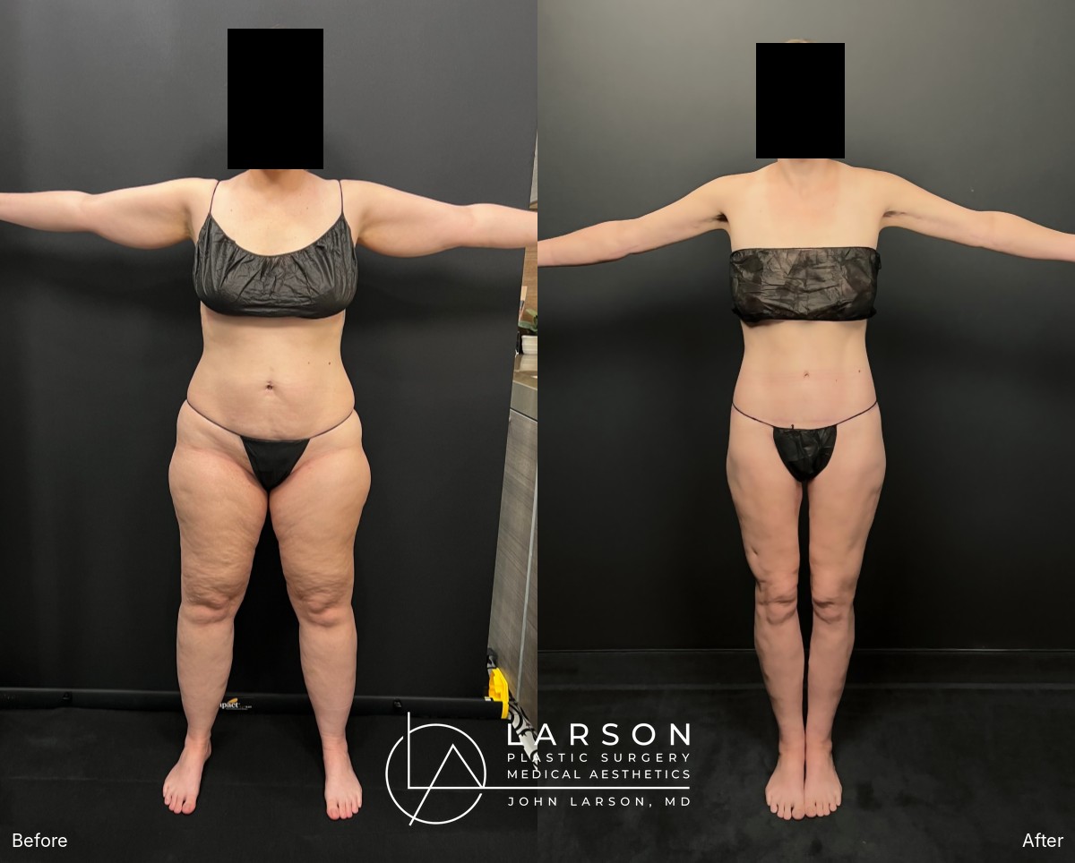 “Before and after staged lipedema liposuction and body lifts in a 42-year-old woman, front view, Newport Beach”