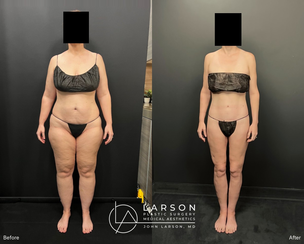 “Before and after staged lipedema liposuction and body lifts in a 42-year-old woman, front view, Newport Beach”