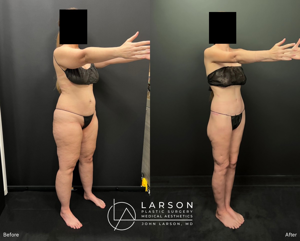 “Before and after staged lipedema liposuction and body lifts in a 42-year-old woman, oblique view, Newport Beach”