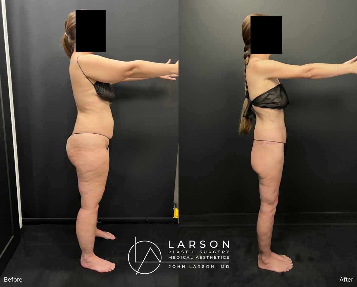 “Before and after staged lipedema liposuction and body lifts in a 42-year-old woman, side view, Newport Beach”