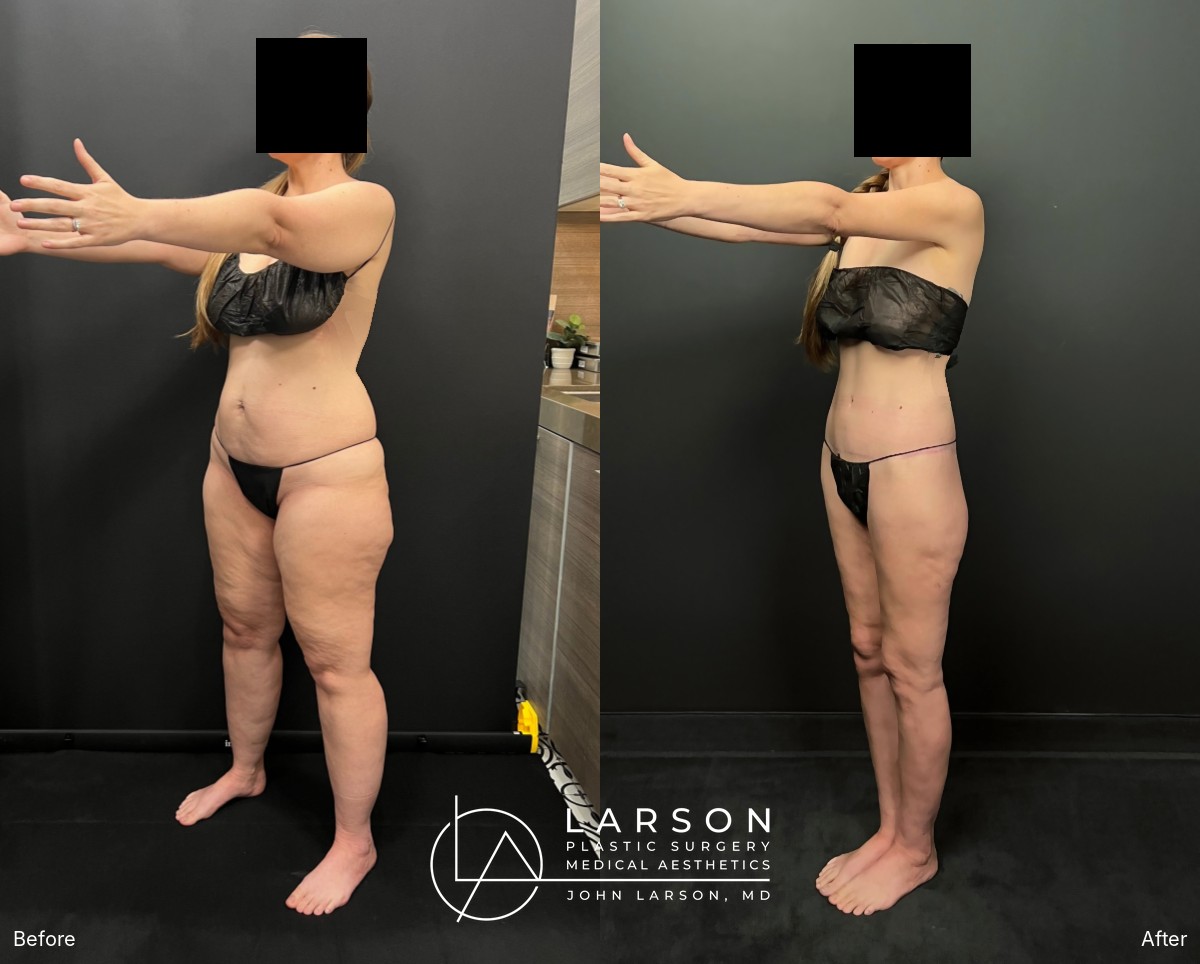“Before and after staged lipedema liposuction and body lifts in a 42-year-old woman, oblique view, Newport Beach”