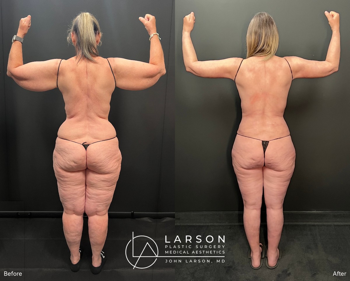 Back view with arms flexed, before and after lipedema arm liposuction and brachioplasty