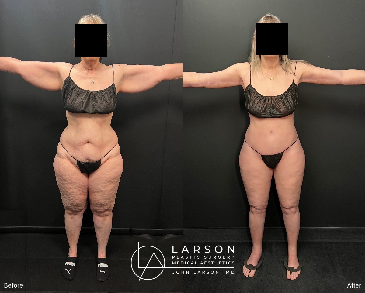 Front view with arms extended, before and nearly 3 months after full-body lipedema liposuction with arm lift and abdominoplasty, Newport Beach