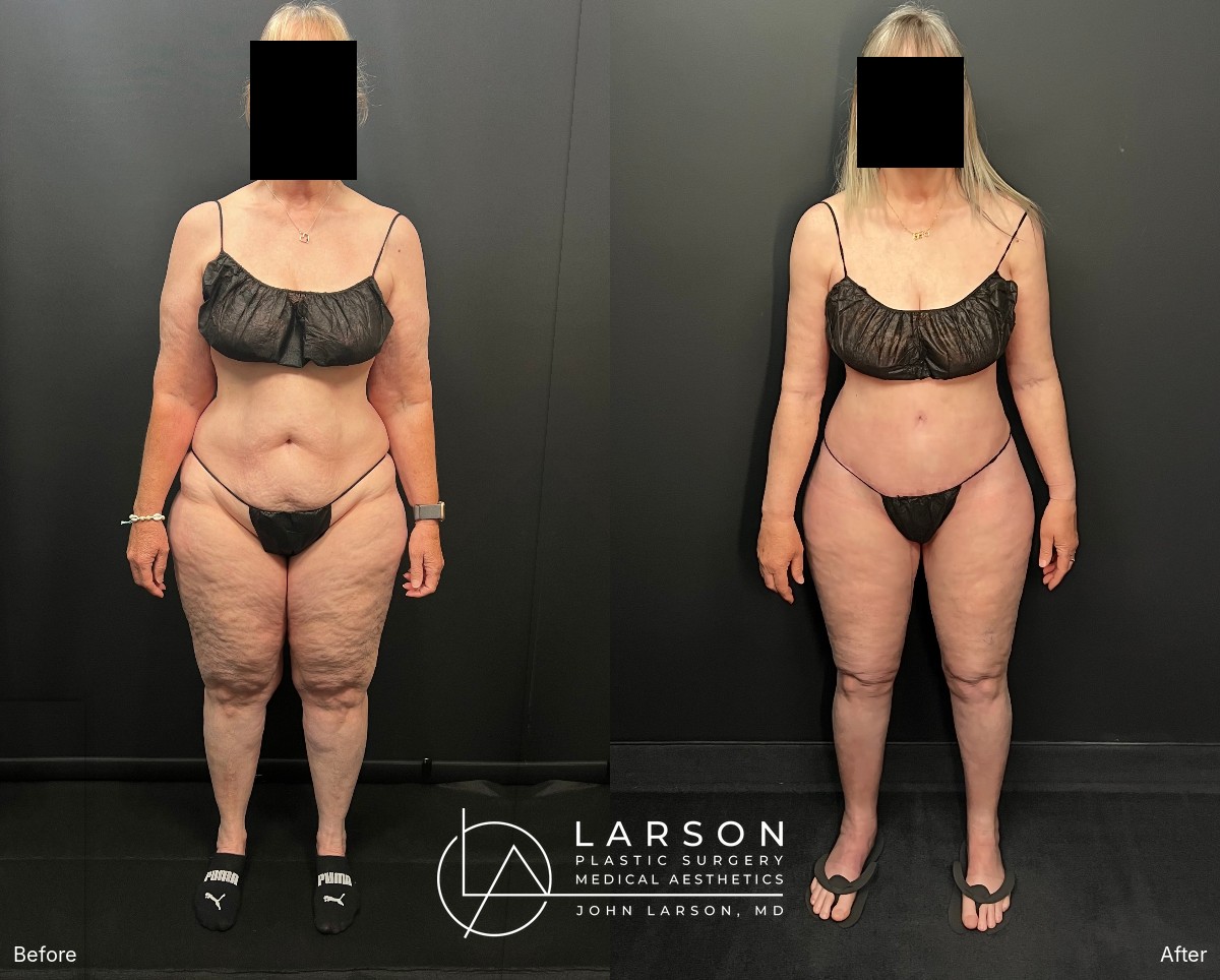 Front view, before and after full-body lipedema surgery on a 62-year-old woman
