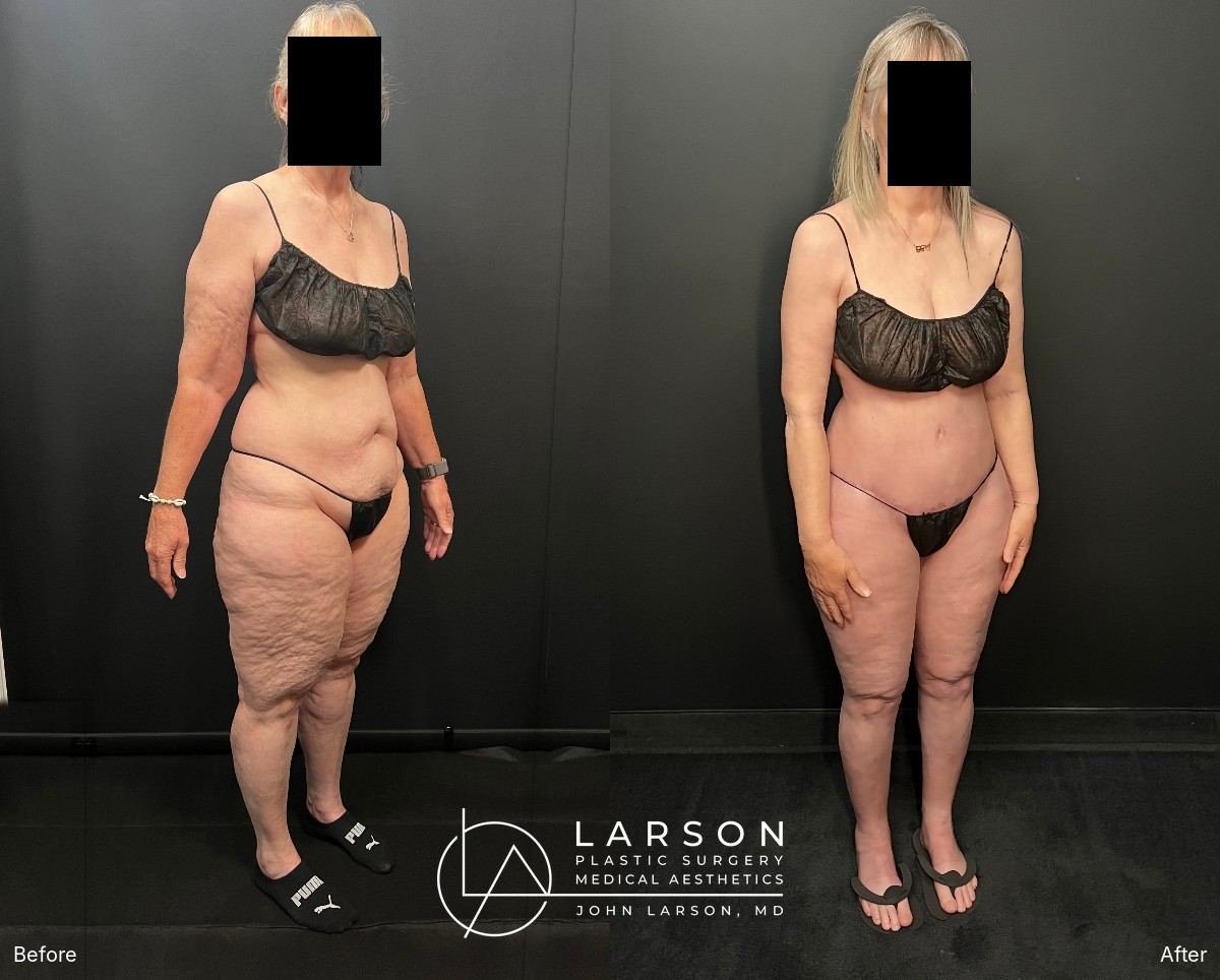 Right oblique view, before and after lipedema liposuction of the abdomen, hips and legs