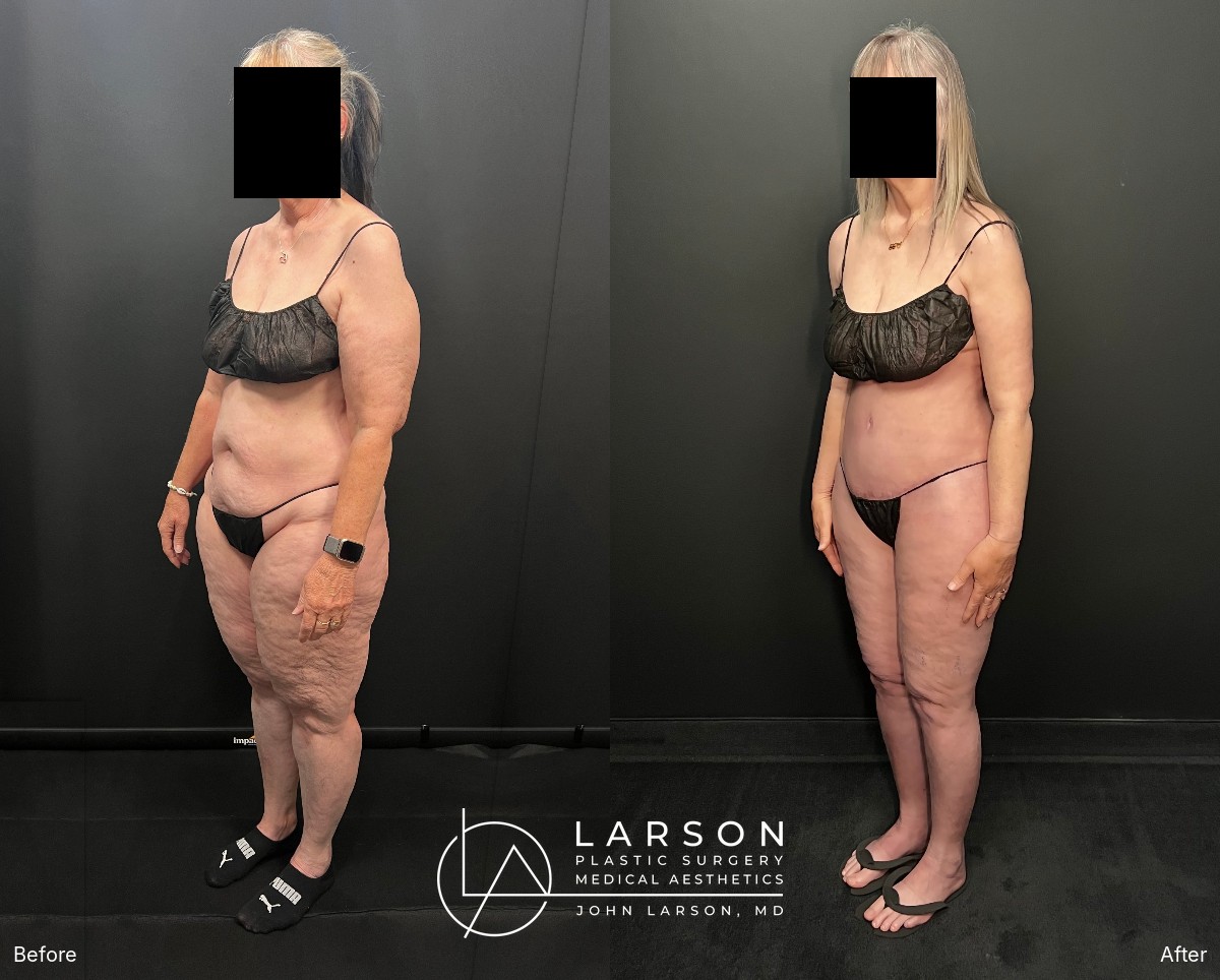 Left oblique view, before and after lipedema liposuction with thigh lift and abdominoplasty