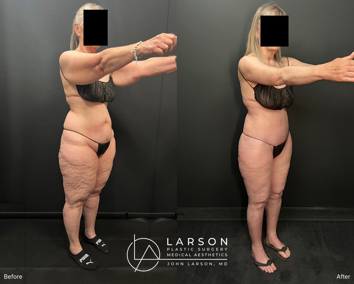 Right oblique view, before and after lipedema liposuction of the abdomen, hips and legs