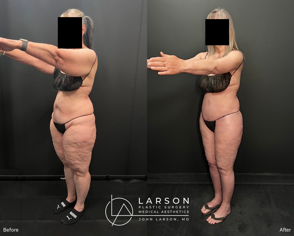 Left oblique view with arms forward, before and after lipedema arm liposuction and arm lift