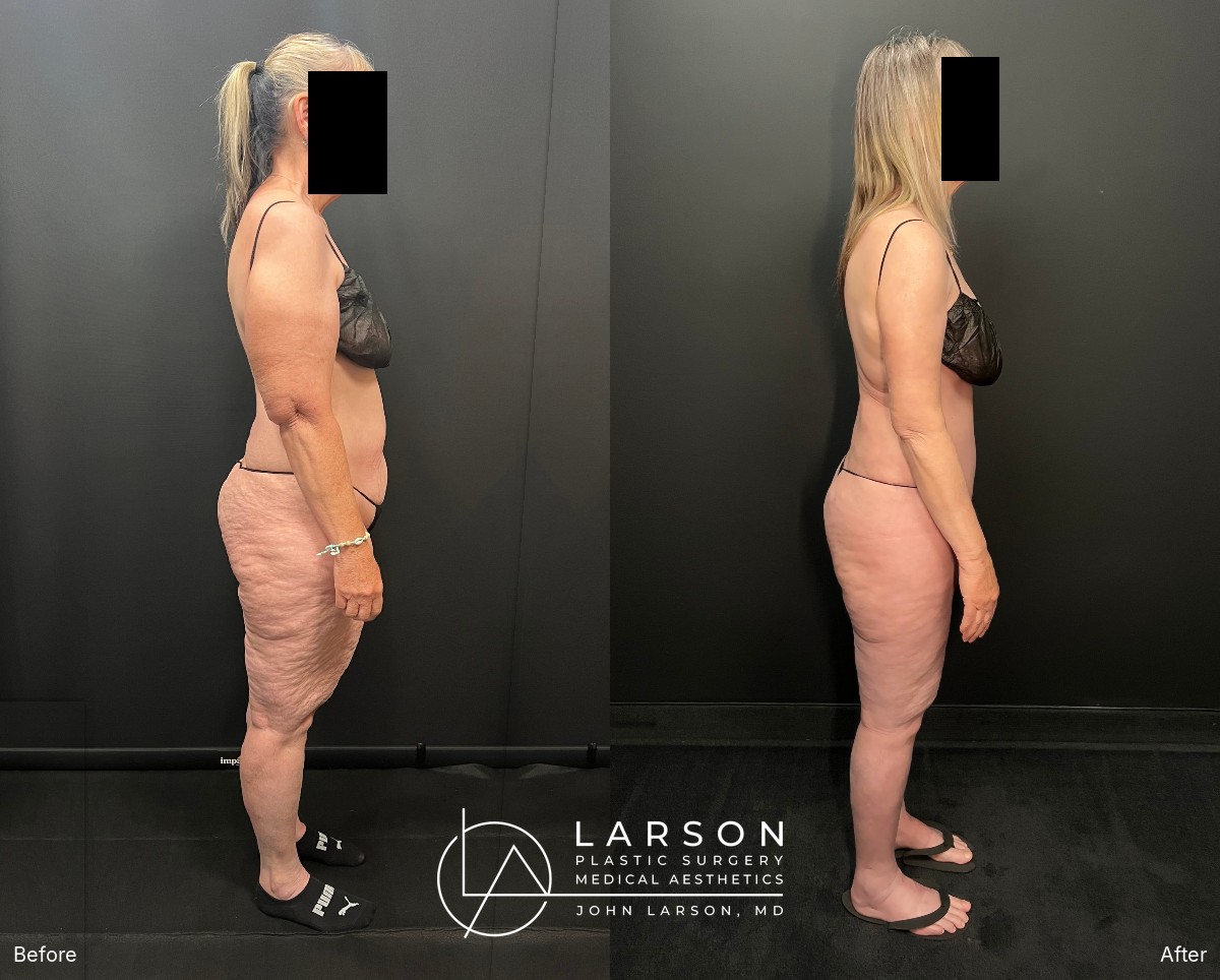 Right side profile, before and after lipedema liposuction and abdominoplasty